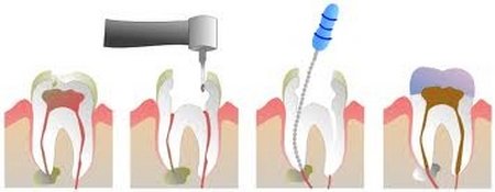 RootCanal_steps1