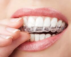 Custom bleaching trays are filled with material and are worn for only 30 minutes each day over 8-14 days for maximum benefit