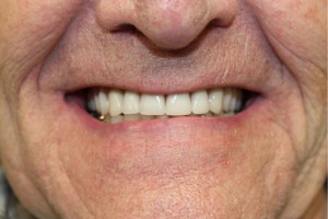 New dentures made at Altman Dental