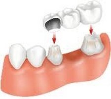 A bridge utilizes your own teeth as anchors, while covering the spaces where teeth have been removed. This is different from a denture, in that the structure built fits on top of existing teeth.