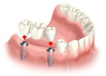 Dental Implant being installed after jaw has been prepared