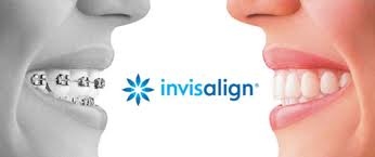 Metal braces can be replaced by Invisalign, the adult choice for mild to moderate orthrodontic correction