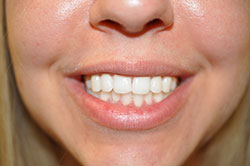 Actual Client after Whitening 