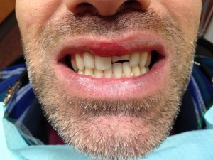 broken tooth to be repaired with a crown at Altman Dental