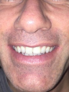Restorative dental crown for broken tooth at Altman Dental
