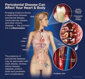 periodontal-disease-affects-heart-body
